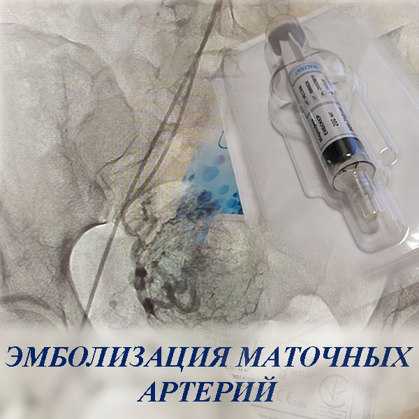 Эмболизация маточных артерий
