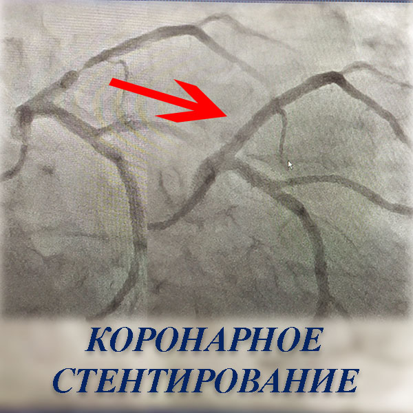 Стентирование сосудов сердца