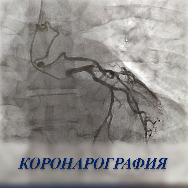 Коронарография