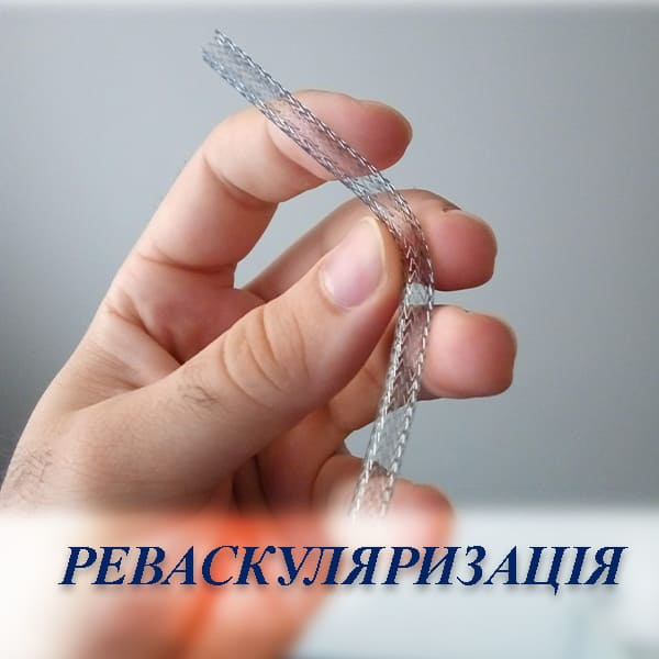 Ендоваскулярна реваскуляризація