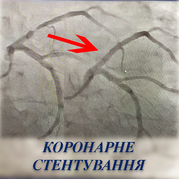 Стентування судин серця