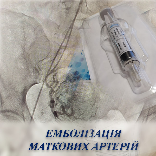 Емболізація маткових артерій